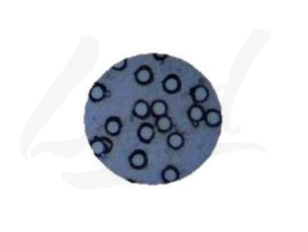 膀胱癌液基新技術(shù)簡(jiǎn)介