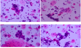 聚焦膜科技創(chuàng)新應(yīng)用，「鄰得膜醫(yī)療」拓展膀胱癌早篩產(chǎn)品